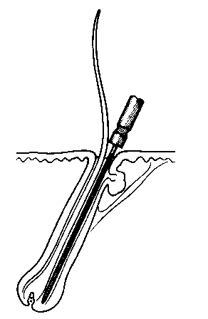 Electrolysis Probe  - Accurate Electrolysis